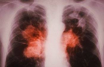 Туберкулез – что это