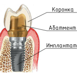Имплантология - инновационные техники для красоты и здоровья зубов